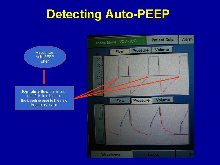 Detecting Auto-PEEP Recognize Auto-PEEP when Expiratory flow continues and fails to return to the