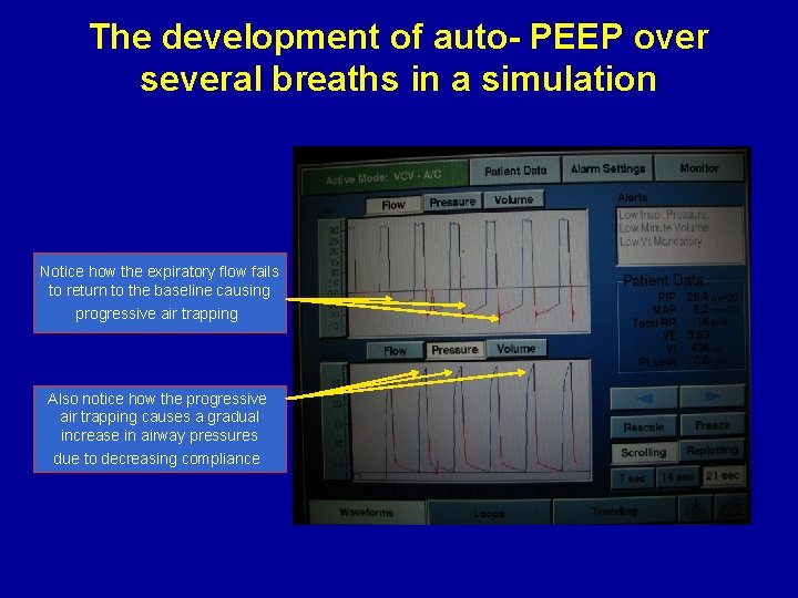 The development of auto- PEEP over several breaths in a simulation Notice how the