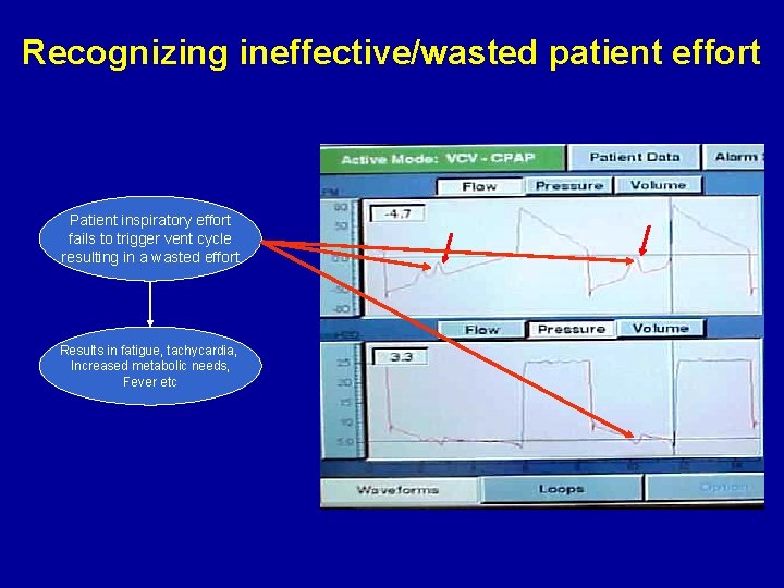 Recognizing ineffective/wasted patient effort Patient inspiratory effort fails to trigger vent cycle resulting in