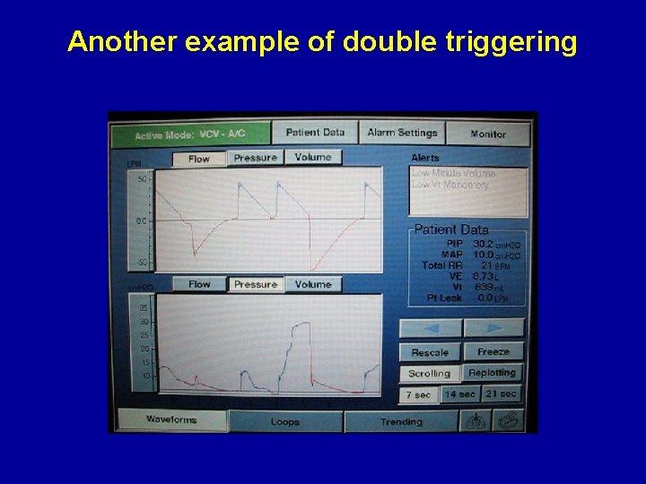 Another example of double triggering Another example of double triggering