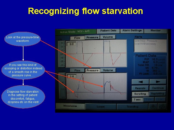 Recognizing flow starvation Look at the pressure-time waveform If you see this kind of