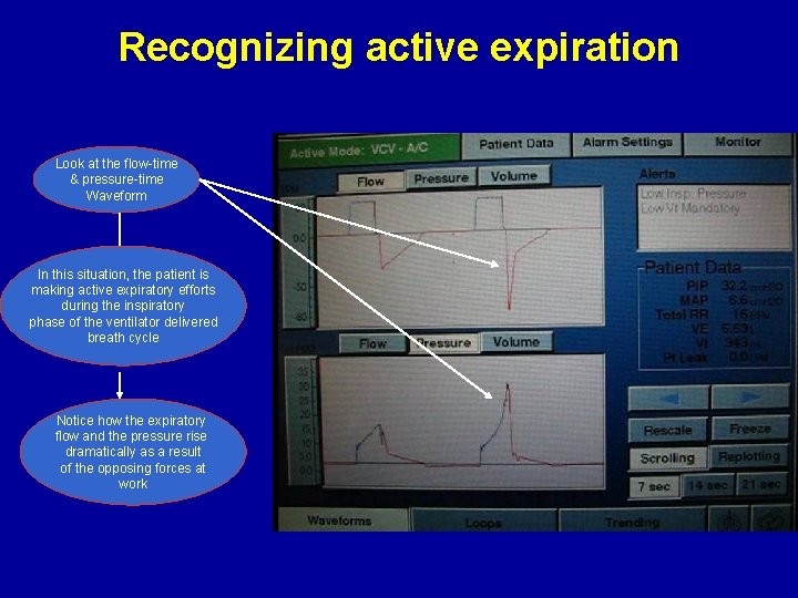 Recognizing active expiration Look at the flow-time & pressure-time Waveform In this situation, the