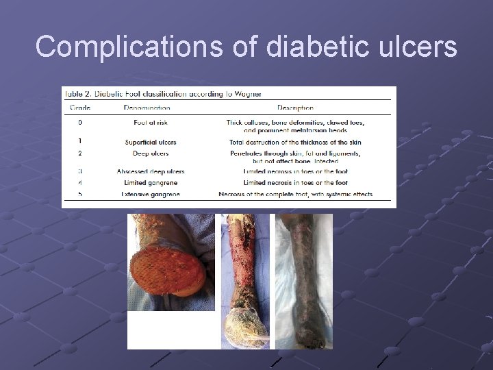Complications of diabetic ulcers 