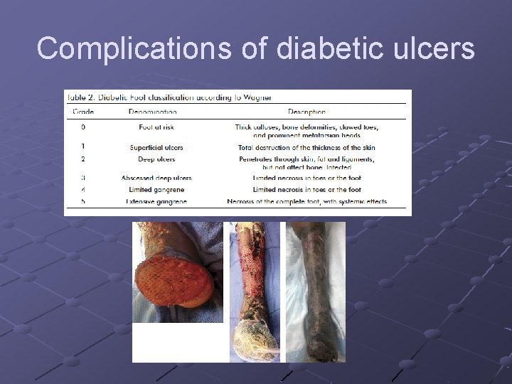 Complications of diabetic ulcers Complications of diabetic ulcers