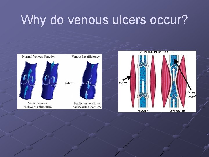Why do venous ulcers occur? 