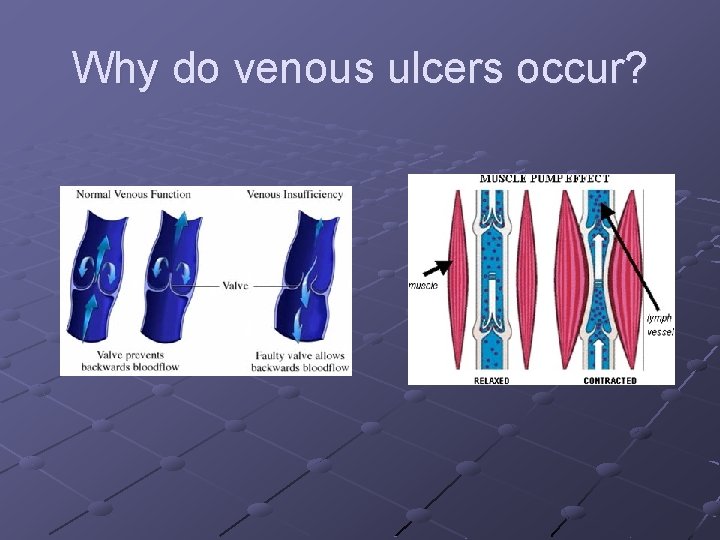 Why do venous ulcers occur? Why do venous ulcers occur?