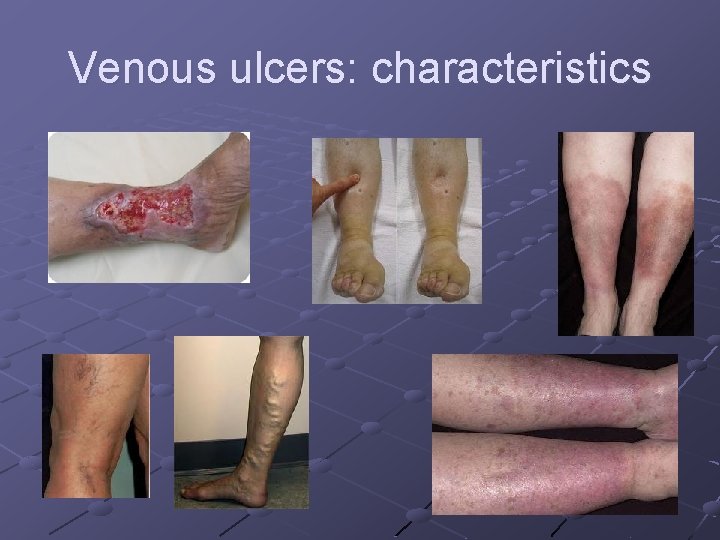 Venous ulcers: characteristics Venous ulcers: characteristics