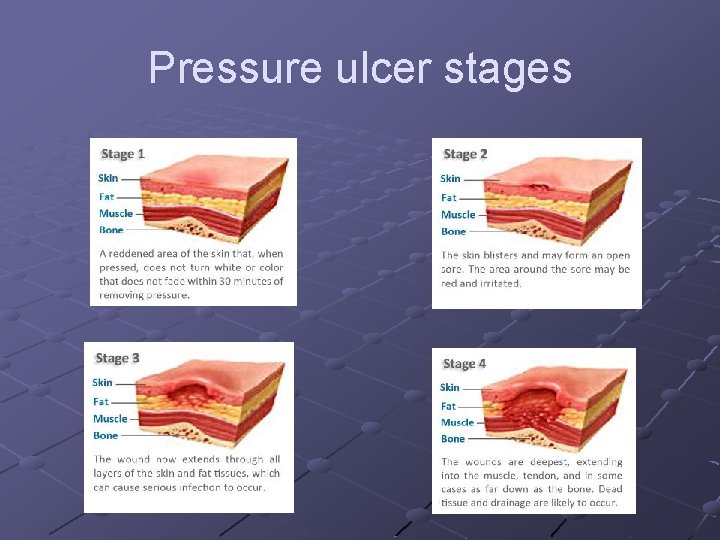 Pressure ulcer stages 