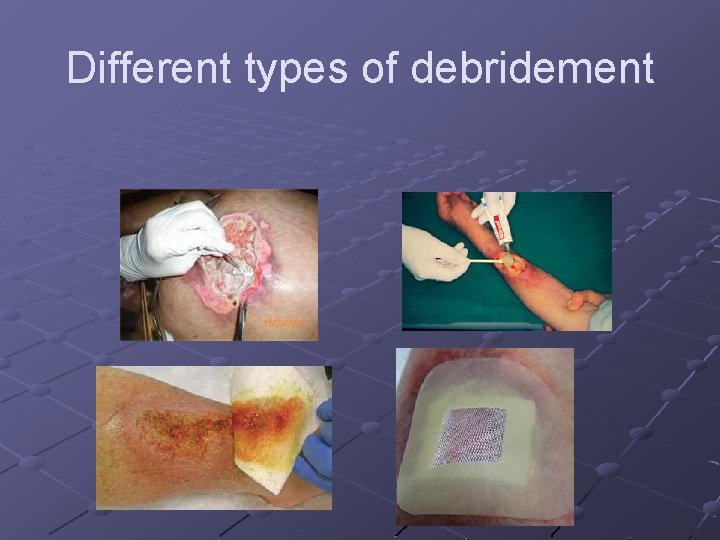 Different types of debridement 