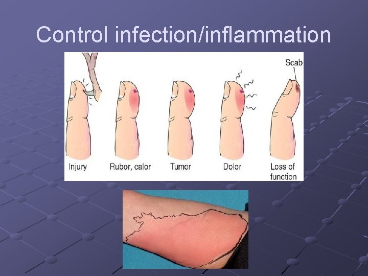 Control infection/inflammation Control infection/inflammation