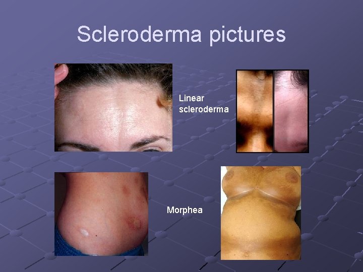 Scleroderma pictures Linear scleroderma Morphea 