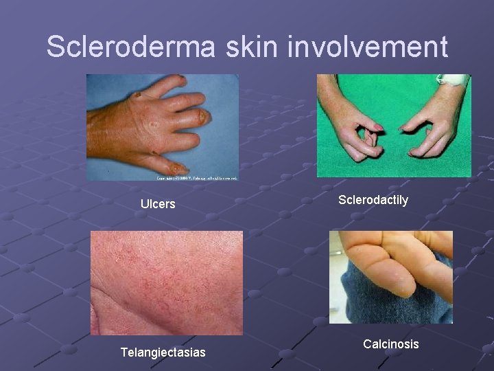 Scleroderma skin involvement Ulcers Telangiectasias Sclerodactily Calcinosis Scleroderma skin involvement Ulcers Telangiectasias Sclerodactily Calcinosis
