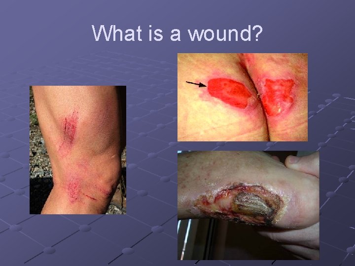 What is a wound? What is a wound?