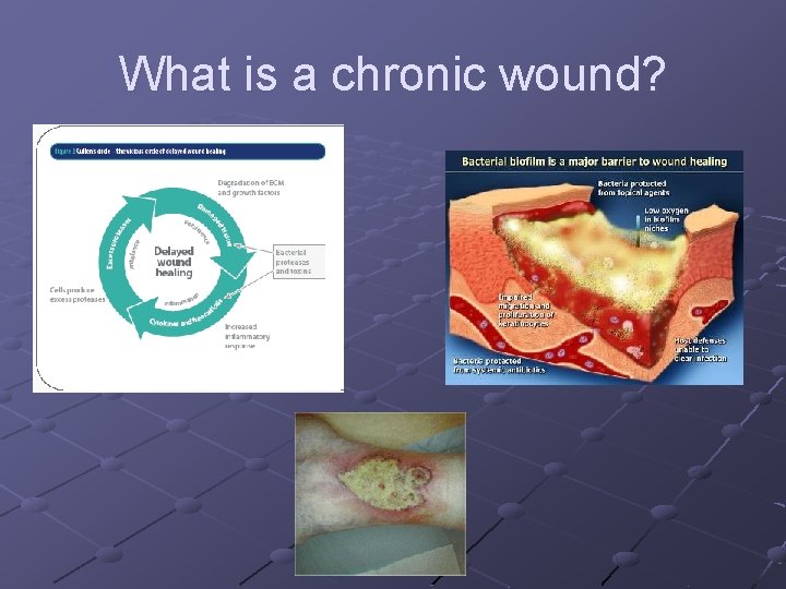 What is a chronic wound? 