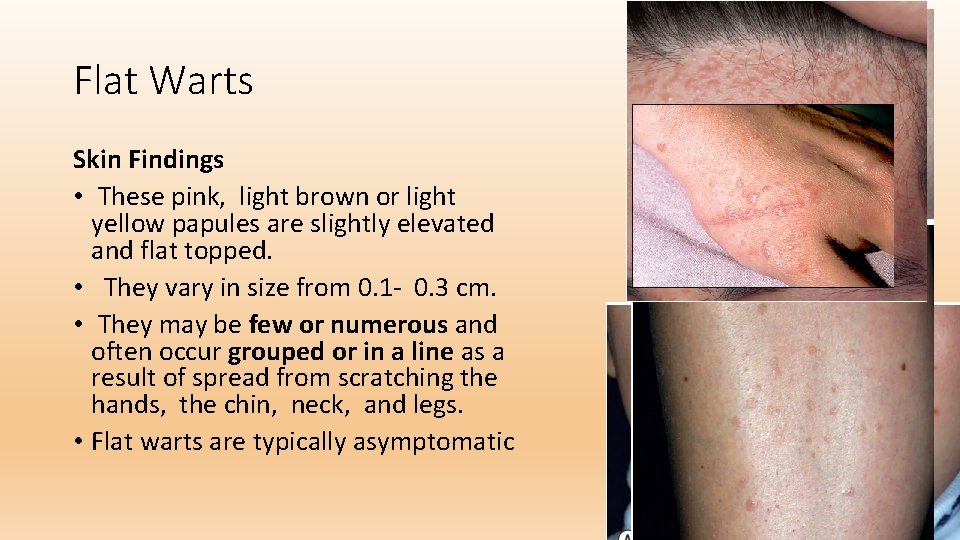 Flat Warts Skin Findings • These pink, light brown or light yellow papules are