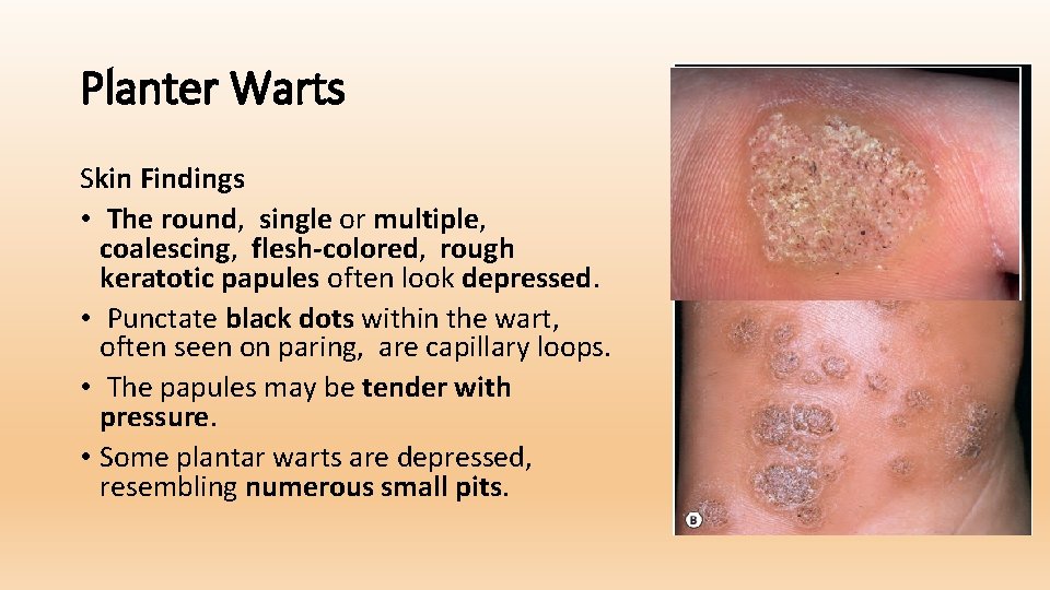 Planter Warts Skin Findings • The round, single or multiple, coalescing, flesh-colored, rough keratotic