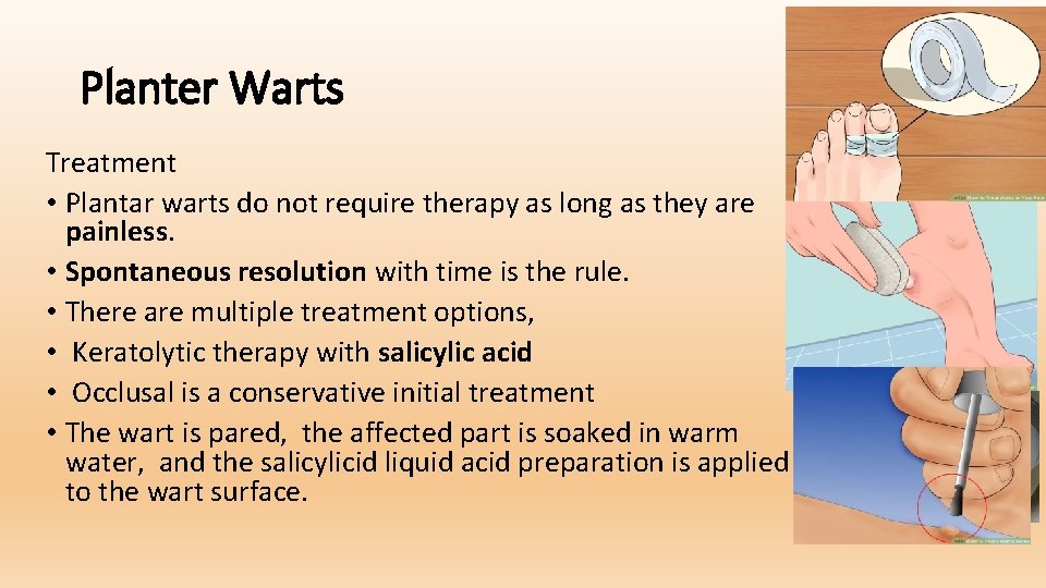 Planter Warts Treatment • Plantar warts do not require therapy as long as they