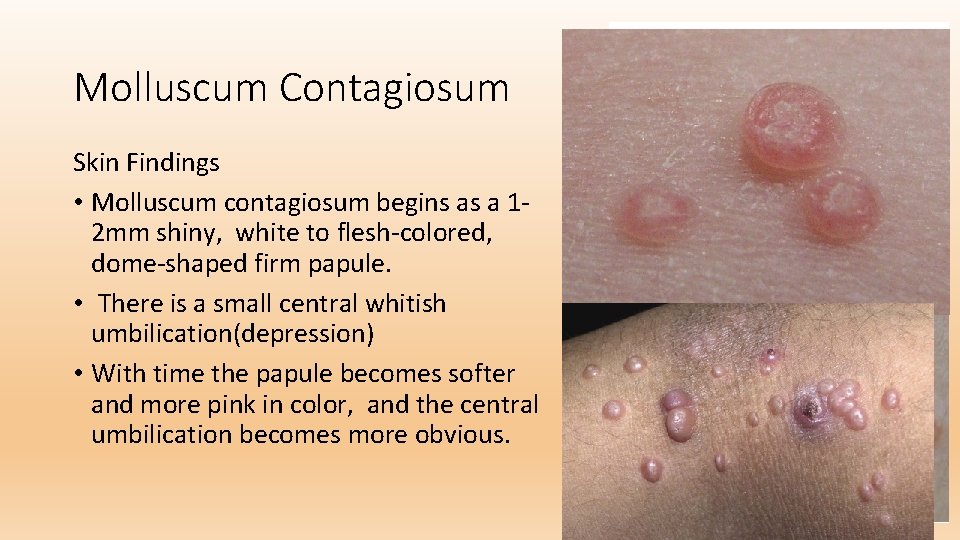 Molluscum Contagiosum Skin Findings • Molluscum contagiosum begins as a 12 mm shiny, white