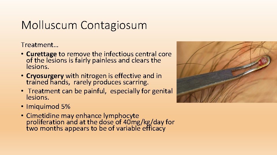 Molluscum Contagiosum Treatment… • Curettage to remove the infectious central core of the lesions