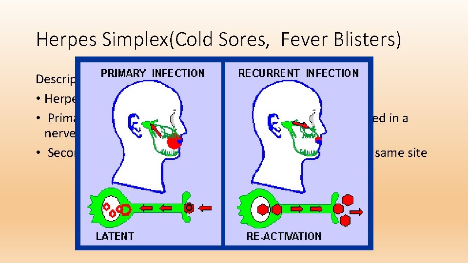Herpes Simplex(Cold Sores, Fever Blisters) Description • Herpes simplex virus infections have two phases: