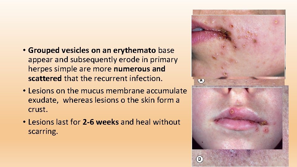  • Grouped vesicles on an erythemato base appear and subsequently erode in primary