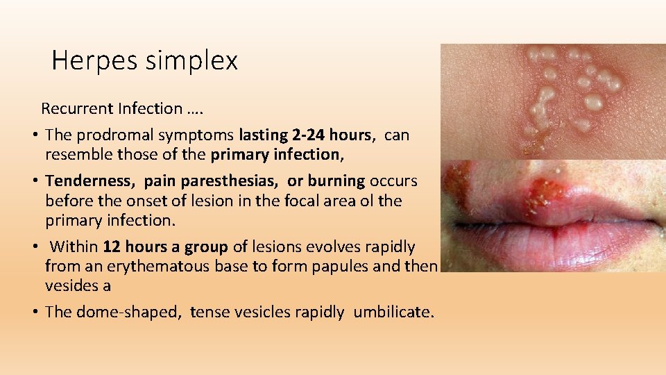 Herpes simplex Recurrent Infection …. • The prodromal symptoms lasting 2 -24 hours, can
