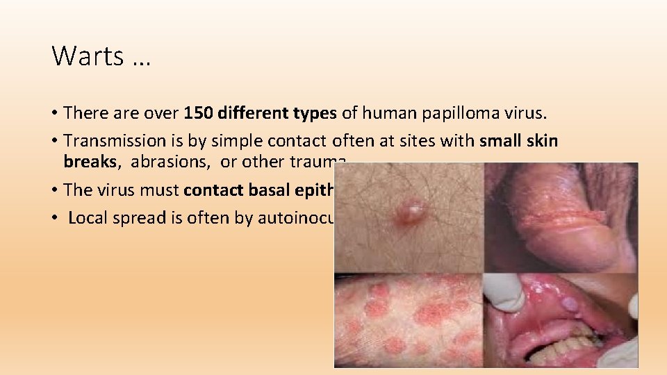 Warts … • There are over 150 different types of human papilloma virus. •