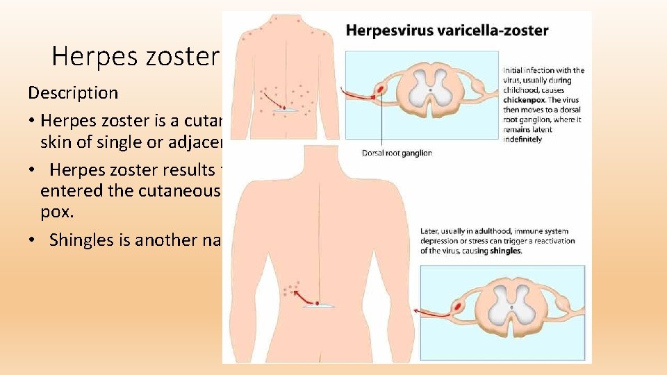 Herpes zoster(Shingles) Description • Herpes zoster is a cutaneous viral infection generally involving the