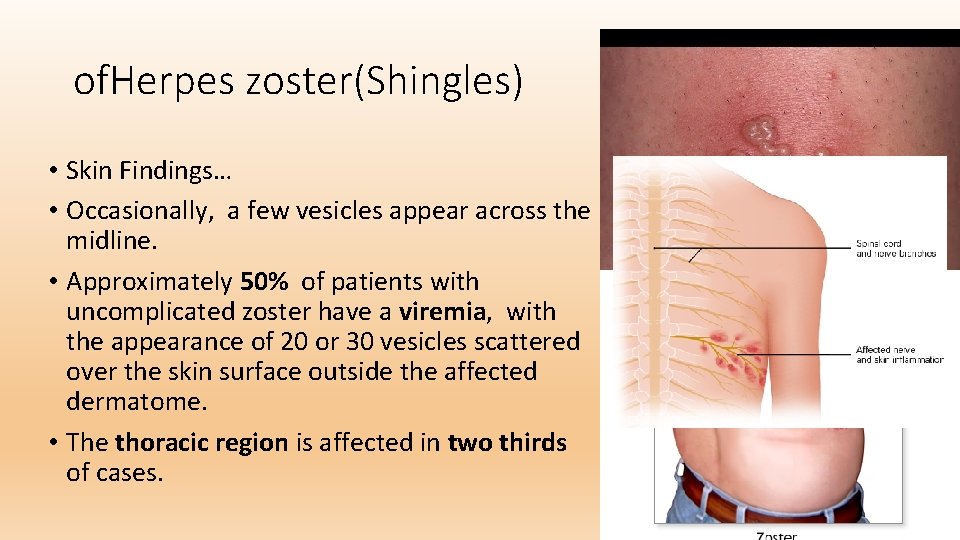 of. Herpes zoster(Shingles) • Skin Findings… • Occasionally, a few vesicles appear across the