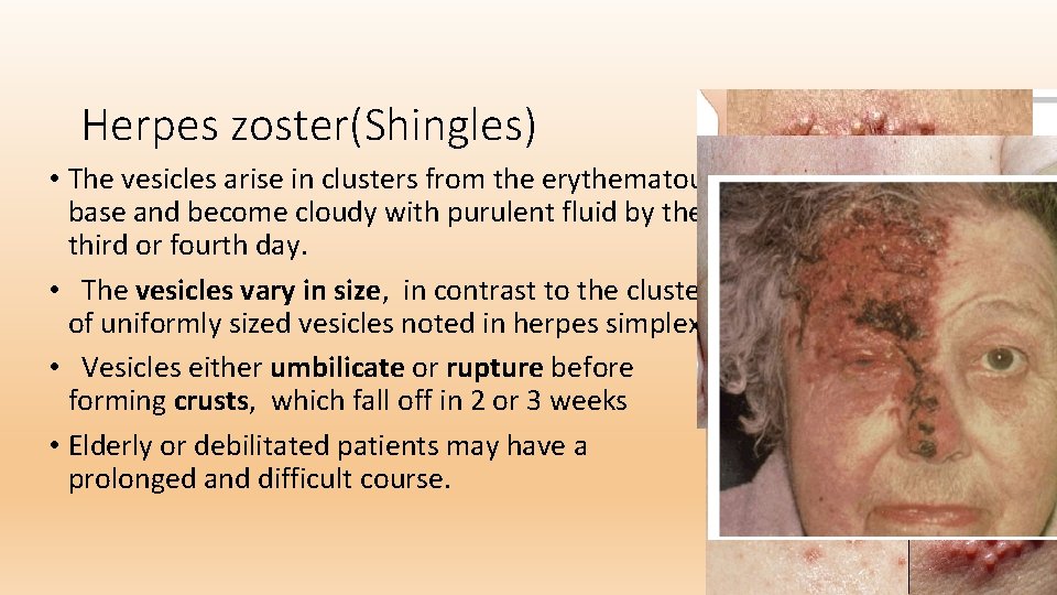 Herpes zoster(Shingles) • The vesicles arise in clusters from the erythematous base and become