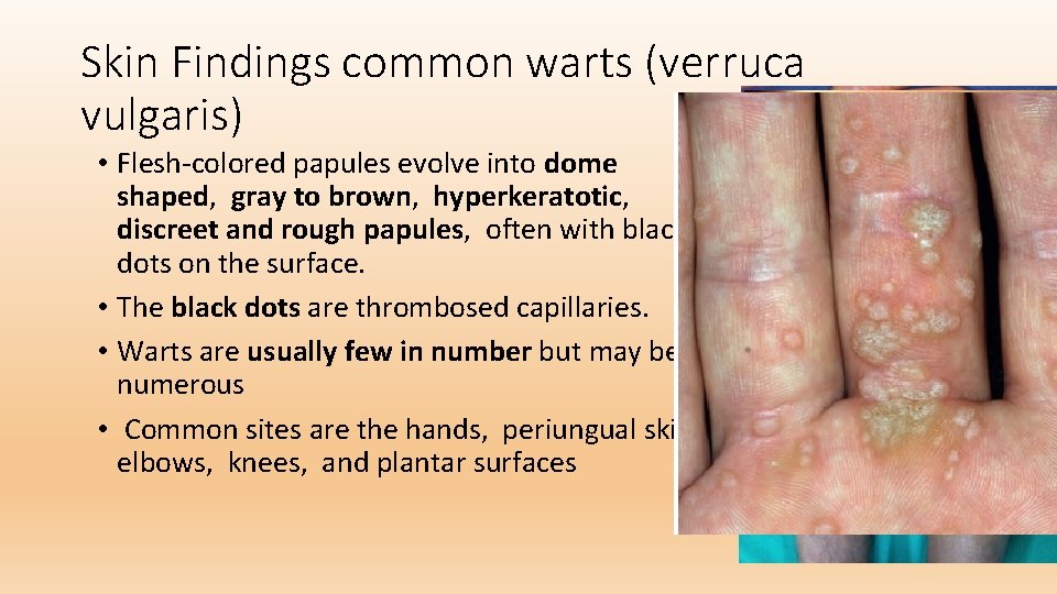 Skin Findings common warts (verruca vulgaris) • Flesh-colored papules evolve into dome shaped, gray