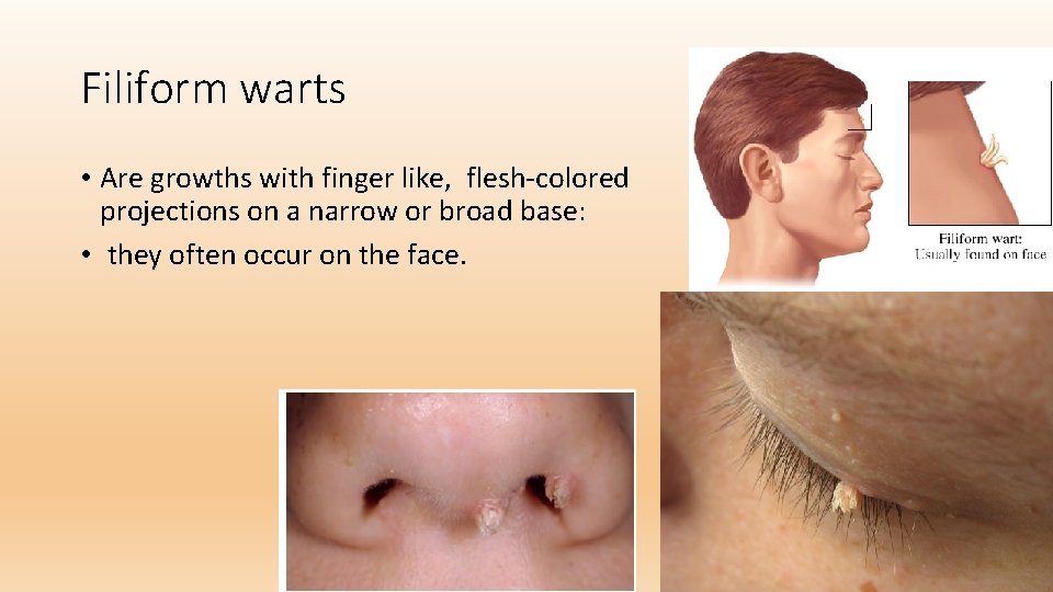 Filiform warts • Are growths with finger like, flesh-colored projections on a narrow or
