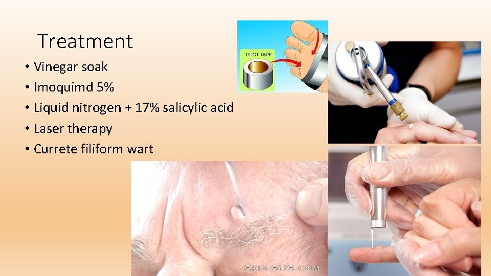 Treatment • Vinegar soak • Imoquimd 5% • Liquid nitrogen + 17% salicylic acid