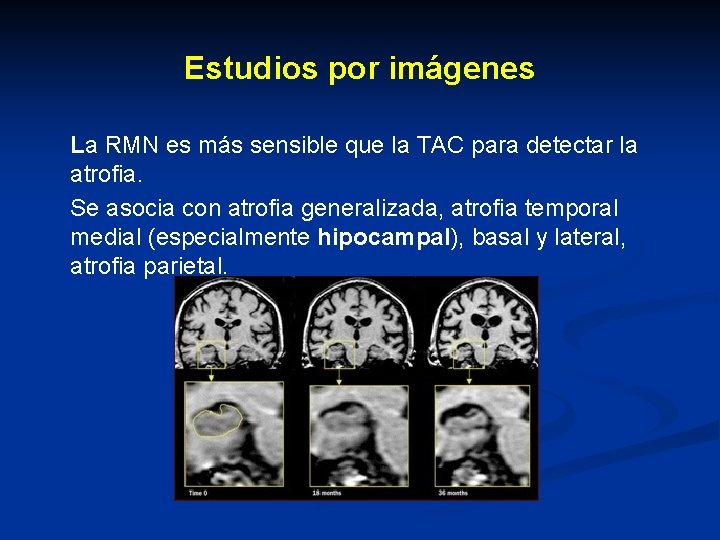 Estudios por imágenes La RMN es más sensible que la TAC para detectar la Estudios por imágenes La RMN es más sensible que la TAC para detectar la