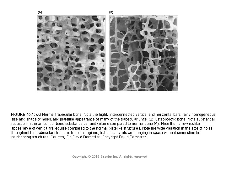 FIGURE 45. 1: (A) Normal trabecular bone. Note the highly interconnected vertical and horizontal