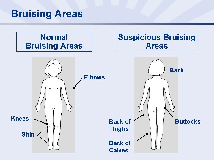 Bruising Areas Normal Bruising Areas Suspicious Bruising Areas Back Elbows Knees Shin Back of