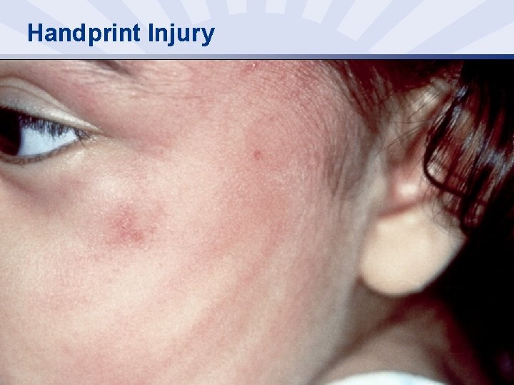 Handprint Injury 