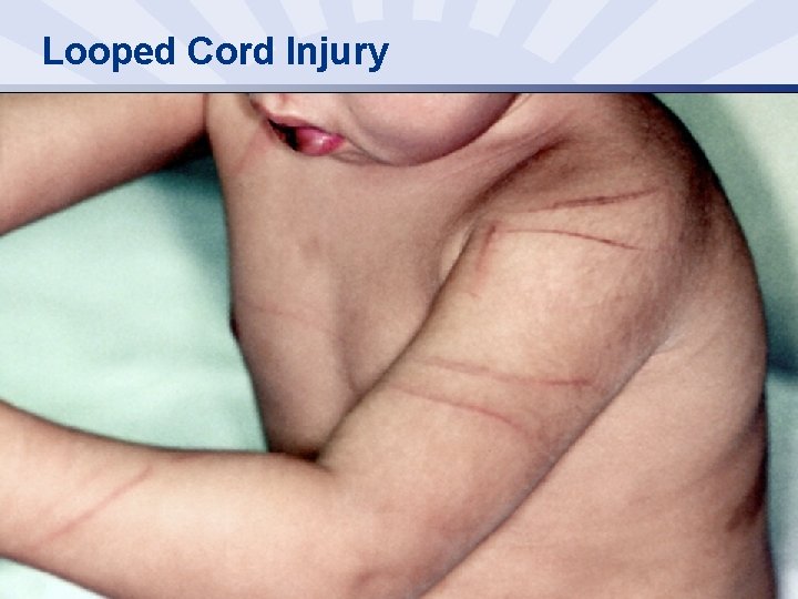 Looped Cord Injury 