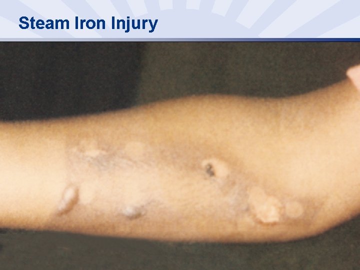 Steam Iron Injury 