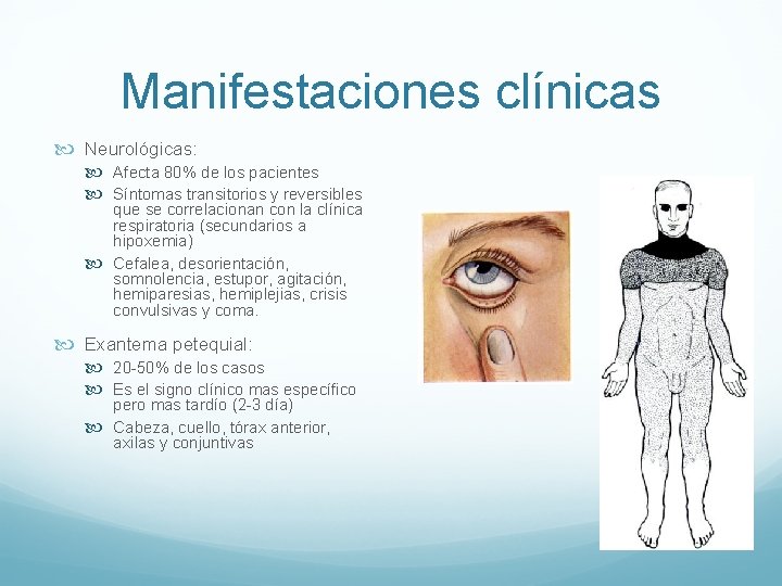 Manifestaciones clínicas Neurológicas: Afecta 80% de los pacientes Síntomas transitorios y reversibles que se