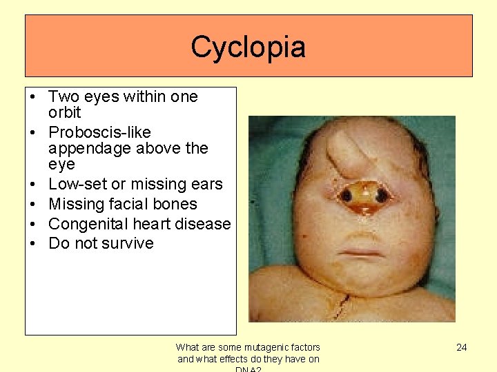 Cyclopia • Two eyes within one orbit • Proboscis-like appendage above the eye •