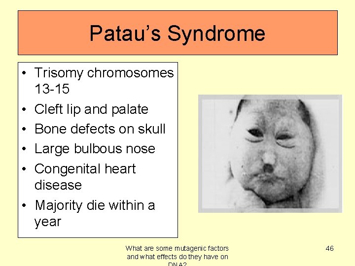 Patau’s Syndrome • Trisomy chromosomes 13 -15 • Cleft lip and palate • Bone