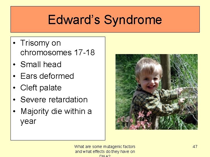 Edward’s Syndrome • Trisomy on chromosomes 17 -18 • Small head • Ears deformed