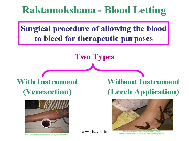 Raktamokshana - Blood Letting Surgical procedure of allowing the blood to bleed for therapeutic