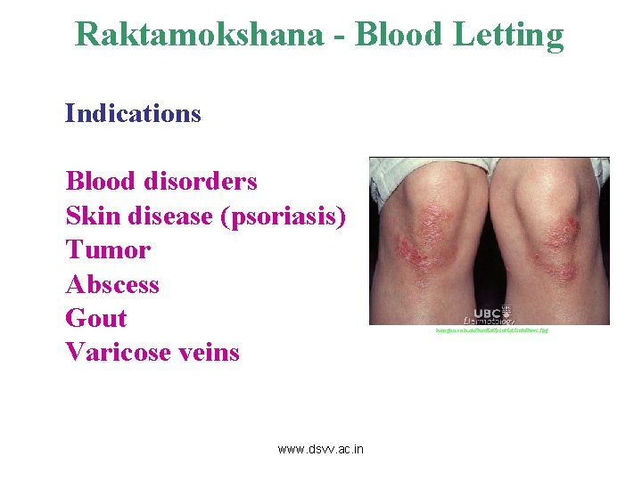 Raktamokshana - Blood Letting Indications Blood disorders Skin disease (psoriasis) Tumor Abscess Gout Varicose