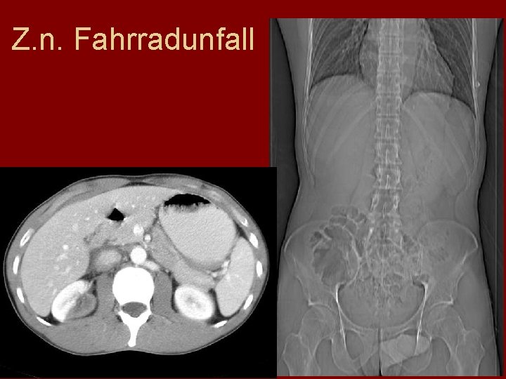 Z. n. Fahrradunfall 