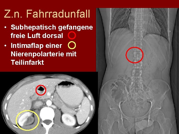 Z. n. Fahrradunfall • Subhepatisch gefangene freie Luft dorsal • Intimaflap einer Nierenpolarterie mit