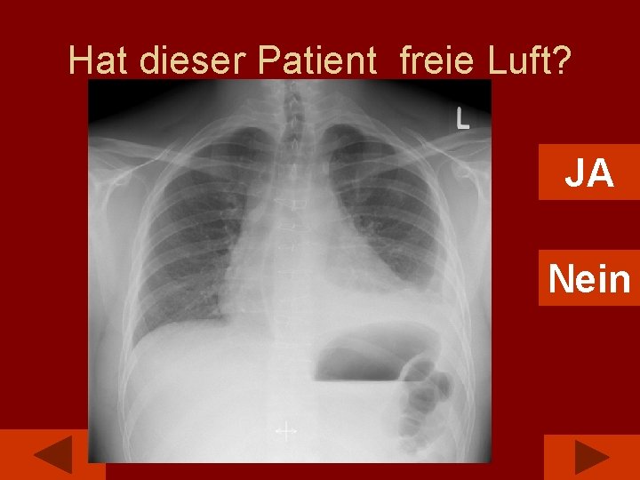 Hat dieser Patient freie Luft? JA Nein 