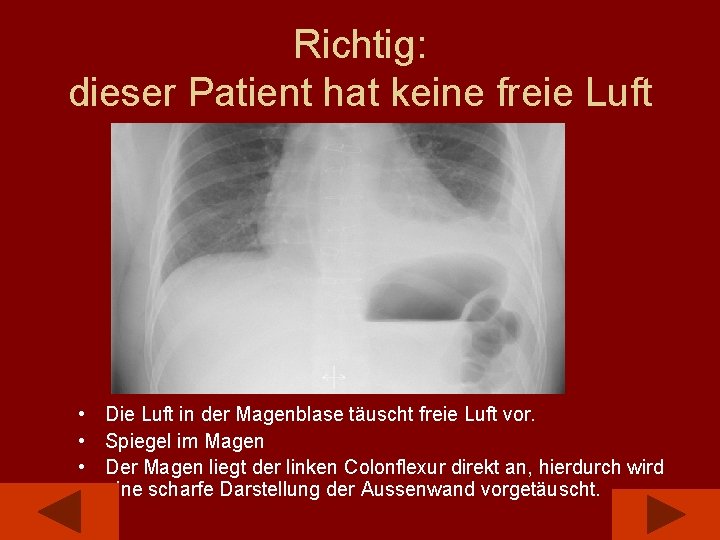 Richtig: dieser Patient hat keine freie Luft • Die Luft in der Magenblase täuscht