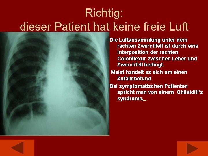 Richtig: dieser Patient hat keine freie Luft Die Luftansammlung unter dem rechten Zwerchfell ist